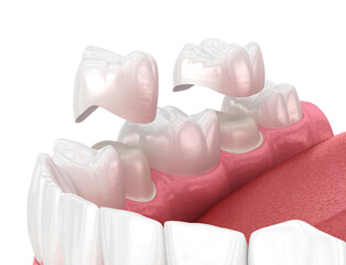 Porcelain crowns placement over premolar and molar teeth. . Medically accurate 3D illustration