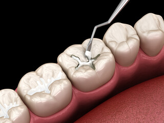 Decayed tooth restoration with composite filling. Dental 3D illustration - 609621871