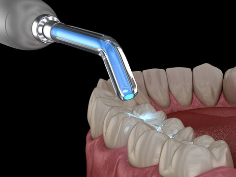 Tooth restoration with filling and polymerization lamp. Dental 3D illustration