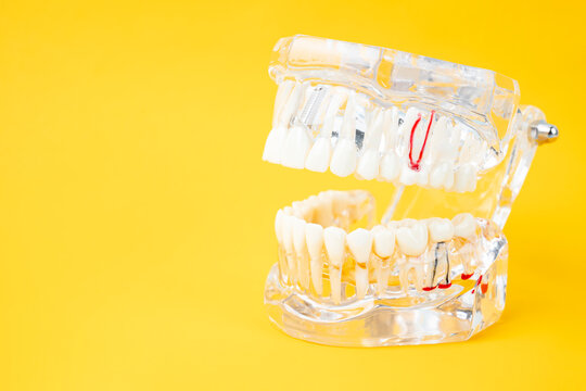 The transparent tooth model with dental implant on yellow background.