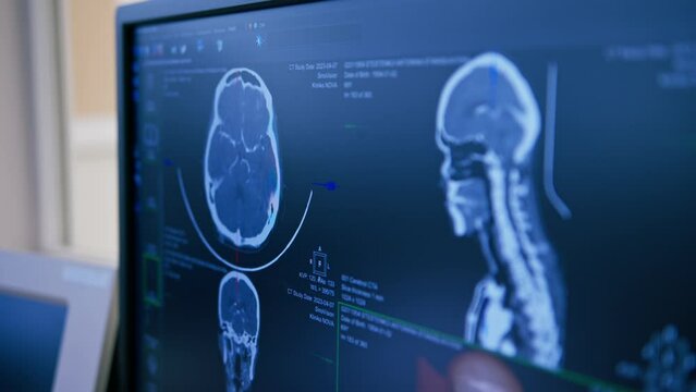 brain computed tomography with tumor 3d rendering image on screen in human body research clinic