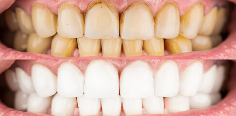 Close-up man Teeth Before And After Whitening. Male teeth before and after whitening, oral care...