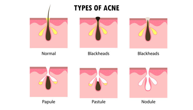 Diagram of the Types of acnes on the skin