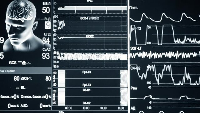 Patient monitor close-up. Monitor with different patient vital signs in hospitals. Image man, head, brains, lines, data, indicators, information. Modern medicine equipment tool. Medical monitor. ECG
