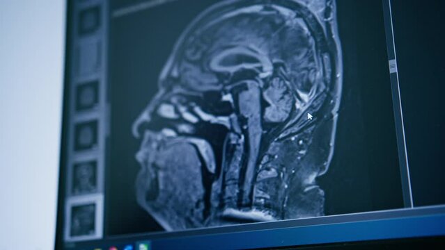 computer tomography brain 3d rendering image on screen brain inflammation disease in clinic
