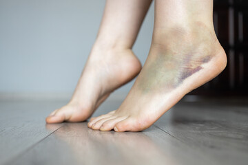 Leg with hematoma. Foot with hematoma. Ankle with bruise. Twisted ankle. Bruise injury on woman foot. Ankle injury with dislocation and sprains. - obrazy, fototapety, plakaty