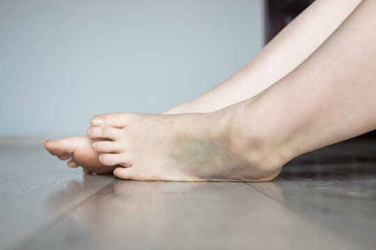 Bruise injury on young woman foot. Close up image of female person sitting on the floor. Leg with hematoma. Twisted ankle. Ankle injury with dislocation and sprains.