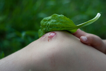 Closeup of fresh bleeding wound on child knee due to fall. child applies plantain leaf to wound....