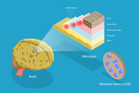 3D Isometric Flat Vector Conceptual Illustration of Meningitis, Human Brain and Meningococcal Bacteria