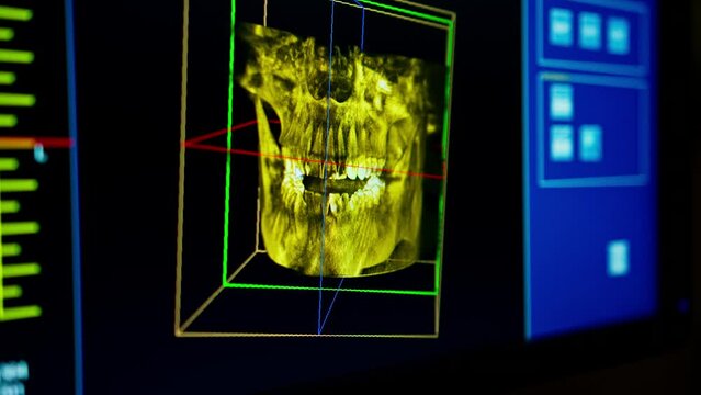 scanning of teeth on an X-ray image of a patient's jaw on a computer screen scaling of the dentition dental clinic