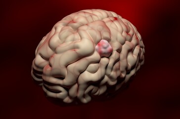 Meningioma (brain cancer) tumor in the brain tissue - 3d illustration isometric view