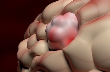 Meningioma (brain cancer) tumor in the brain tissue - 3d illustration closeup view - obrazy, fototapety, plakaty