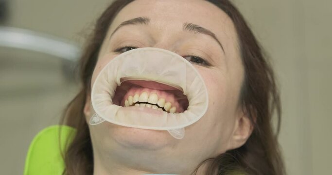 Woman with silicone retractor in mouth moves teeth in funny way. Reception at dentist, dental treatment.