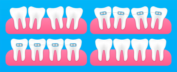 Correction of teeth with orthodontic braces. Stages of teeth alignment, before and after correction with brackets. Dental model of teeth in the gum. Vector Illustration.