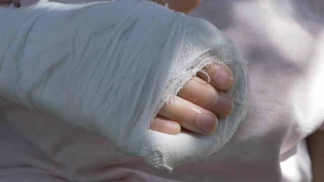 Plaster or cast on broken hand of female elderly person after accident. Fractured limb. Woman's arm is broken. fracture injury. plaster cast on hand