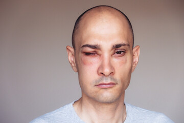 Caucasian man has angioedema around the eyes caused by allergic reaction to agents such as insect...