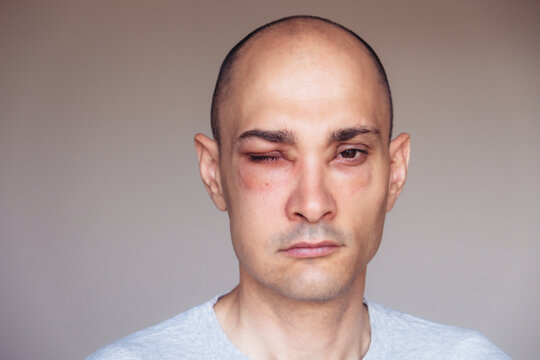 Caucasian man has angioedema around the eyes caused by allergic reaction to agents such as insect bites, foods, or medications. Swollen face.