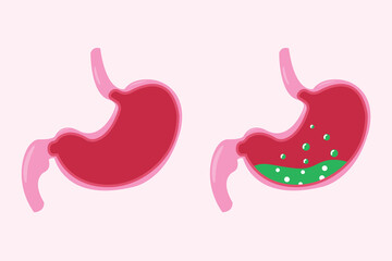 Stomach icon set, cartoon vector illustration. cross section of normal and abnormal stomach