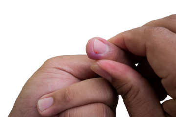 selective focus on bruised middle fingernails due to ingrown nails. in Indonesian it is called cantengan. paronychia disease.