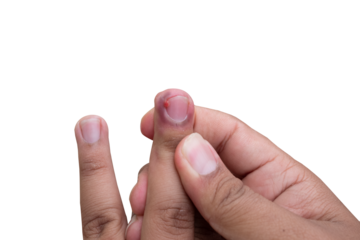 selective focus on bruised middle fingernails due to ingrown nails. in Indonesian it is called cantengan. paronychia disease.