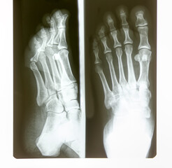 foot radiography black and white film roentgen