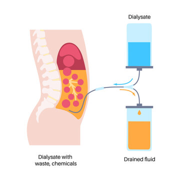 Peritoneal dialysis concept