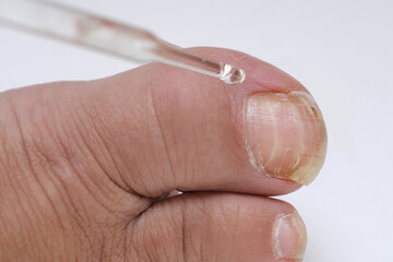 dermatologist, dermatovenereologist, podologist treats damaged rude nail on big toe of female foot,...