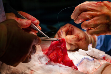 Surgical operation, closeup on operating field and hands of surgeons