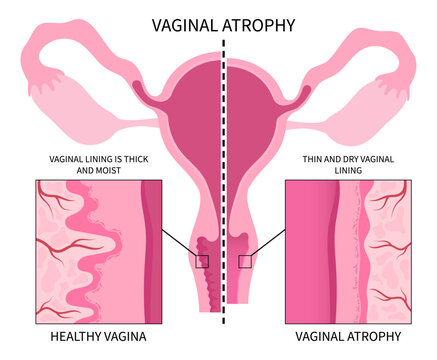 Vaginal Atrophy Level Cervix Drying Pain Tract Or UTI Canal Cycle Stop Postmenopausal Screen Exam Of Pap Smear Test Cancer Pelvic With Birth Control Pills