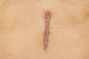 Close up of Scar caused by abdominal aorta surgery in elderly men. Cyanotic keloid Scars caused by abdominal surgery and suturing. skin imperfections or defects.