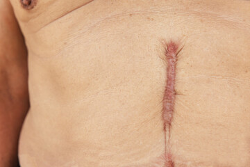 Close up of Scar caused by abdominal aorta surgery in elderly men. Cyanotic keloid Scars caused by abdominal surgery and suturing. skin imperfections or defects.
