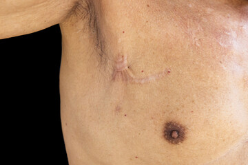 Fototapeta premium Close up of Scar caused by abdominal aorta surgery in elderly men. Cyanotic keloid Scars caused by abdominal surgery and suturing. skin imperfections or defects.