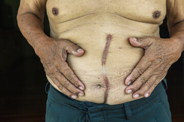 Close up of Scar caused by abdominal aorta surgery in elderly men. Cyanotic keloid Scars caused by...