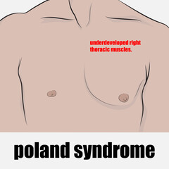 Poland syndrome absence or unilateral underdevelopment of the right pectoralis major muscle in its majority.