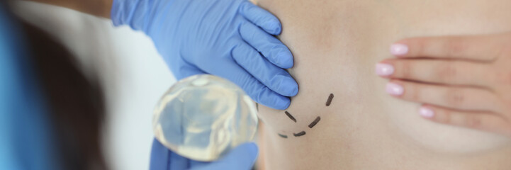 Surgeon holds silicone implant for breast augmentation. Restoration of the breast in women after...