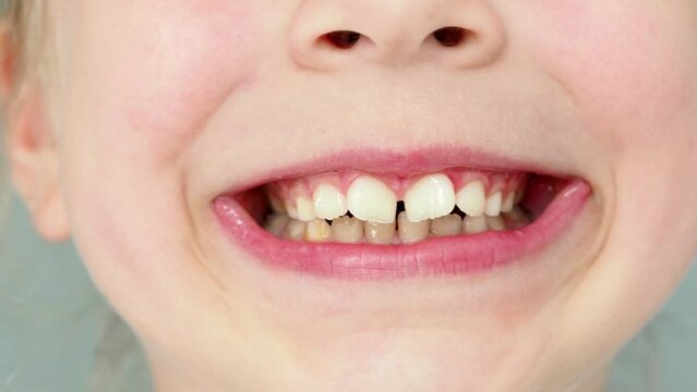 close up of a person with a smile. Beautiful children's smile large. mouth, smile close-up. Malocclusion. Children's dentistry. Broad smile. Teeth coarse