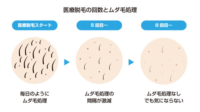医療脱毛の回数とムダ毛処理