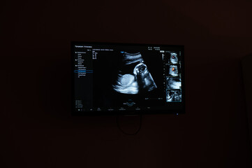 Screen shot of a second trimester prenatal screening. - obrazy, fototapety, plakaty
