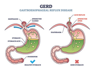 GERD or gastroesophageal reflux disease with digestive acid outline diagram. Labeled educational scheme with medical heartburn feeling cause and compared with healthy process vector illustration. - obrazy, fototapety, plakaty