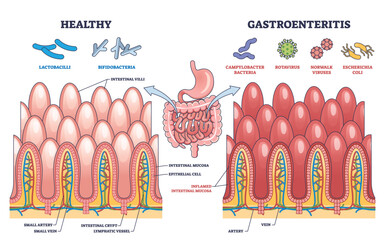 Gastroenteritis or stomach flu microbiological explanation outline diagram. Labeled educational scheme with healthy and bacteria, rotavirus or coli affected intestine comparison vector illustration.