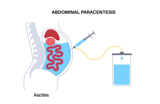 Abdominal paracentesis poster