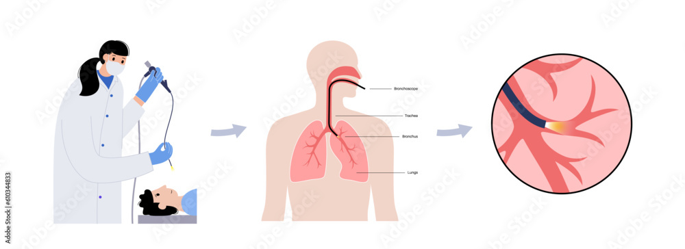 Wall mural Bronchoscopy procedure concept