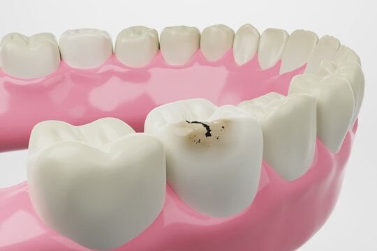 Tooth decay isolated white background 3D rendering.