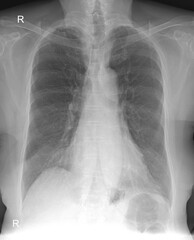 x ray image of chest