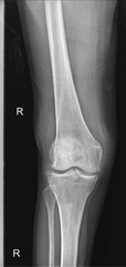 x ray image of knee