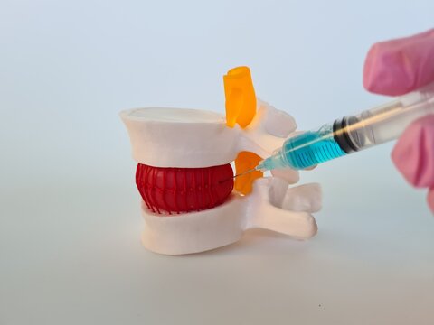 Model of the human spine on in doctor uses a syringe to make an injection blockade into a hernia of spine