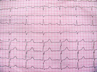 Naklejka premium Electrocardiogram example of a normal 12-lead sinus rhythm, close up
