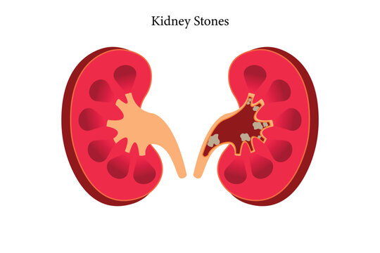 Nephrolithiasis kidney stones disease. cross section of Vector medical illustration. eps 10