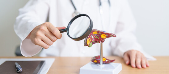 Doctor with human Liver model and Magnifying glass. Liver cancer and Tumor, Jaundice, Viral Hepatitis A, B, C, D, E, Cirrhosis, Failure, Enlarged, Hepatic Encephalopathy and Ascites Fluid in Belly - obrazy, fototapety, plakaty