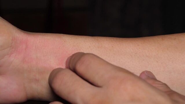 Slow motion speed closeup scene of hand scratching on arm, rash from plant allergic, itchy from mosquito attack in nature environment, bump on skin after bug bite, weather change itch